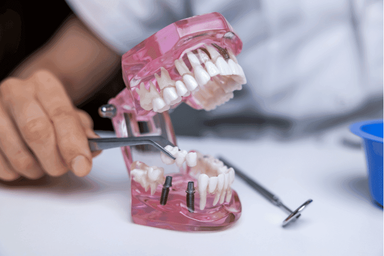 Dental Bridges at Smile Lounge