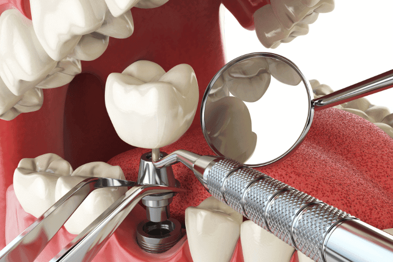 Dental Crowns at Smile Lounge