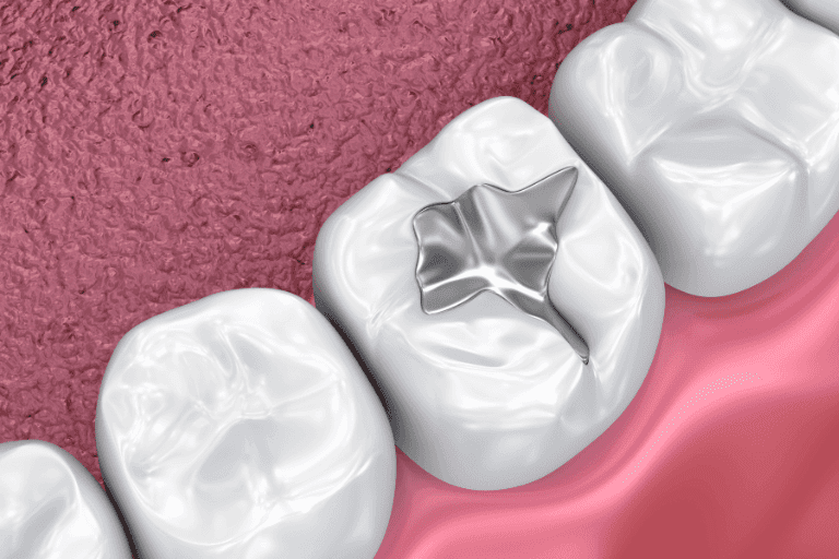 Dental Fillings at Smile Lounge