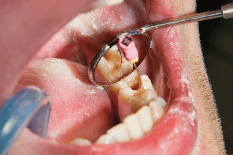 Dental Fillings at Smile Lounge