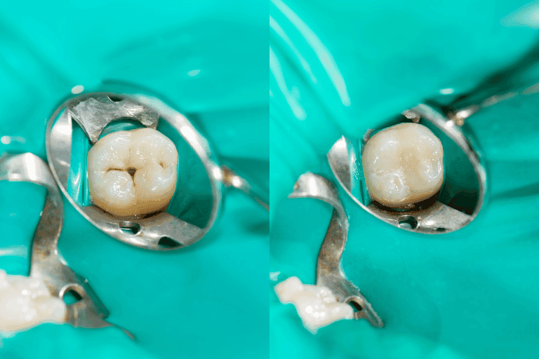 Dental Fillings at Smile Lounge