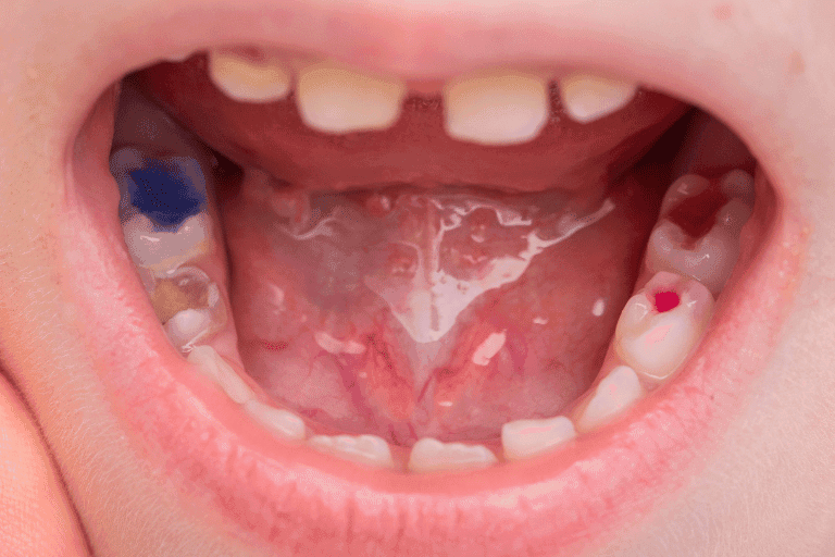 Dental Fillings at Smile Lounge