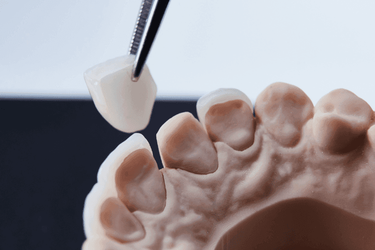 Dental Veneers at Smile Lounge