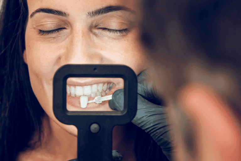Dental Veneers at Smile Lounge
