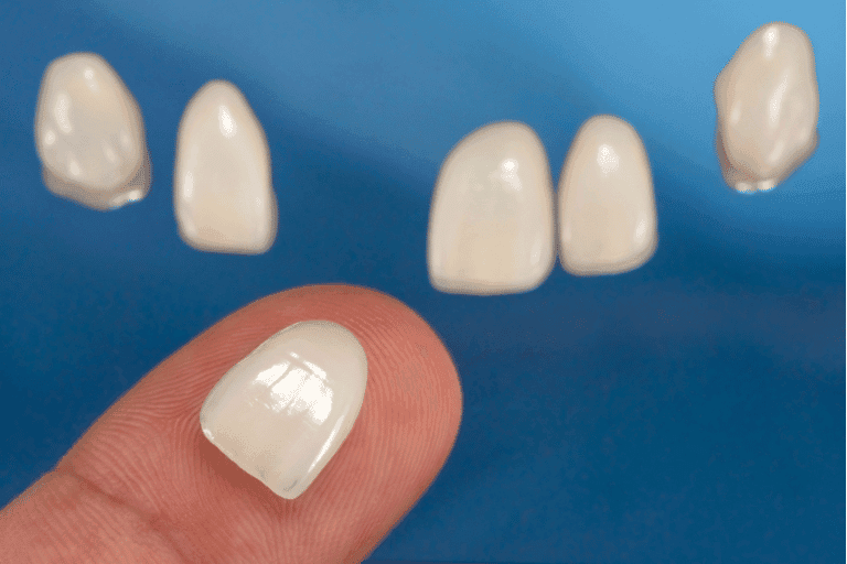 Dental Veneers at Smile Lounge