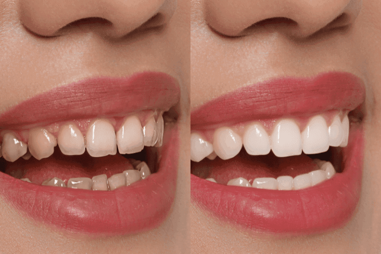 Dental Veneers at Smile Lounge