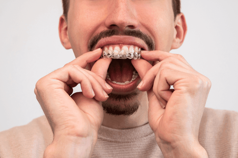Invisalign at Smile Lounge