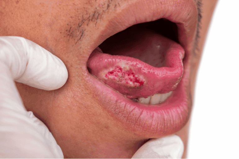 Oral Cancer Screening at Smile Lounge