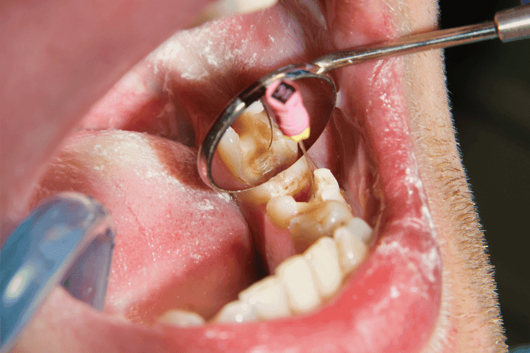 Root Canal Treatment at Smile Lounge