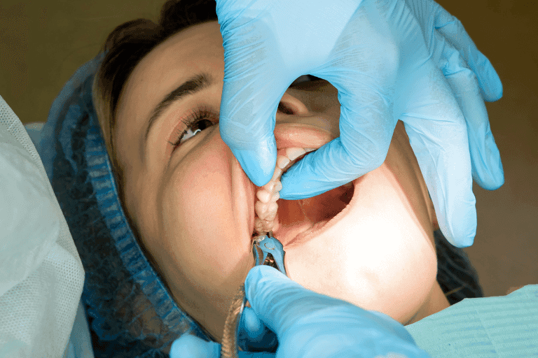 Wisdom Teeth Extraction at Smile Lounge
