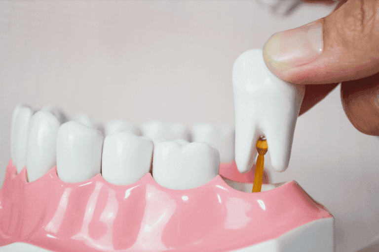 Wisdom Teeth Extraction at Smile Lounge