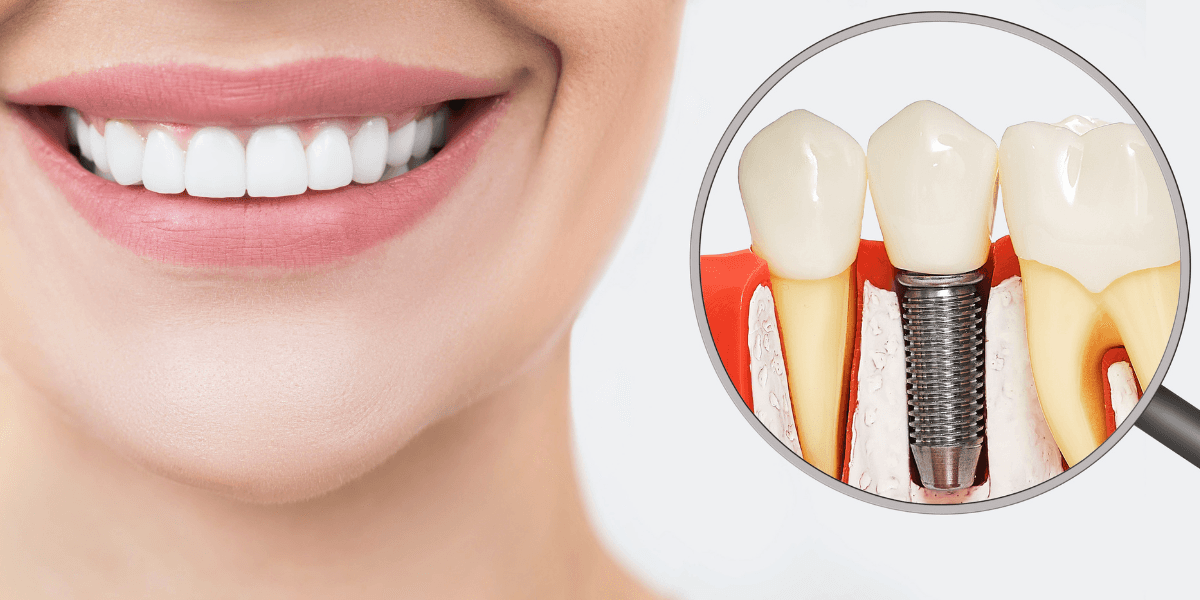 Dental implants at Smile Lounge Dentistry in Milton