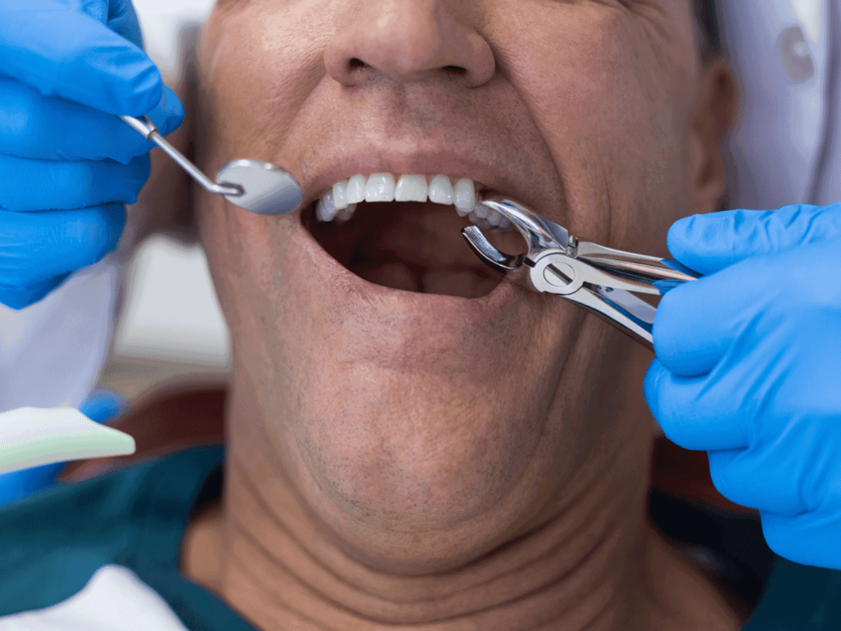 Teeth extraction at Smile Lounge Dentistry in Milton