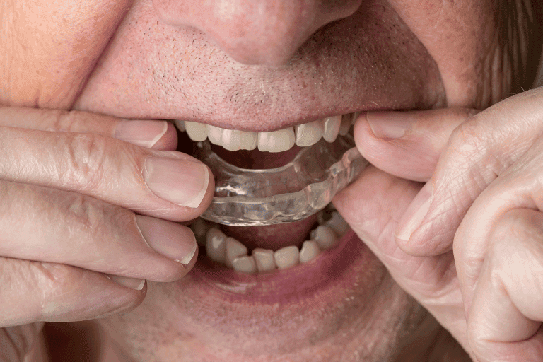 Dental Mouth Guards at Smile Lounge
