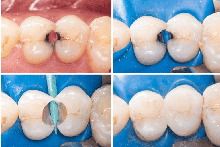Dental Sealents at Smile Lounge