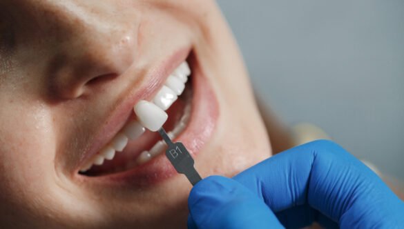 What Is a Dental Cap? Complete Guide to Dental Crowns in 2025