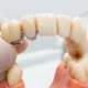 How Much Does a Dental Bridge Cost? Discover the Real Price of Restoring Your Smile!