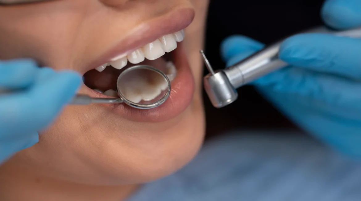 What Are the Types of Dental Fillings? A Complete Guide for Patients