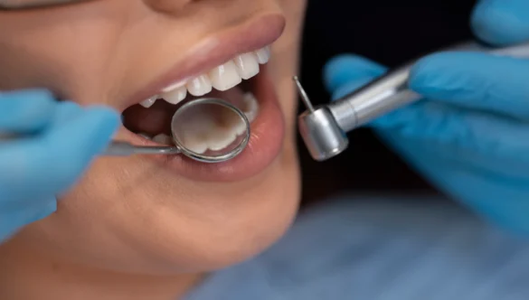 What Are the Types of Dental Fillings? A Complete Guide for Patients